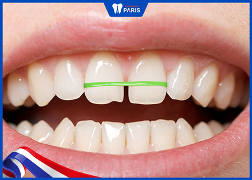 Dùng chun buộc răng kéo sát lại - Cách làm răng đều không cần niềng tại nhà