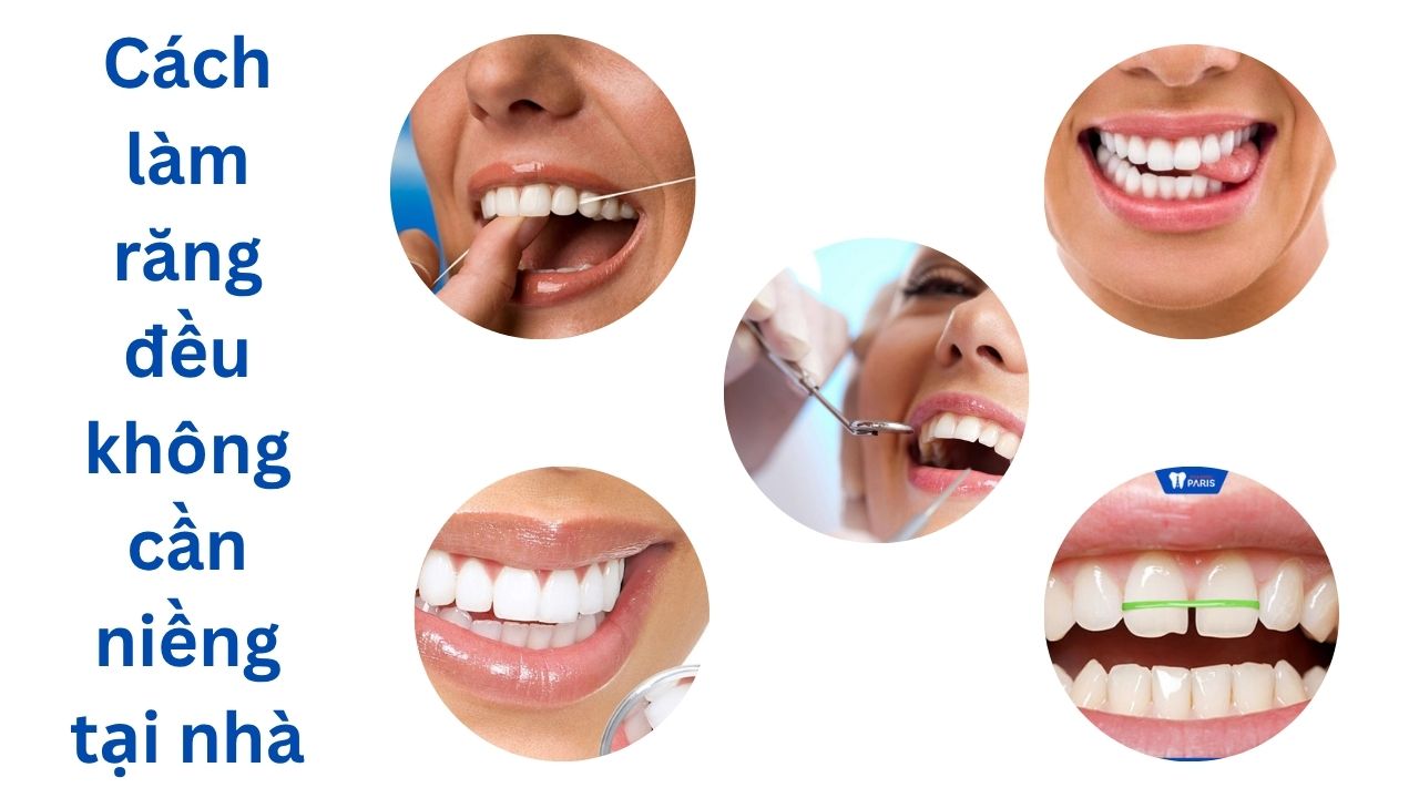 Cách làm răng đều không cần niềng tại nhà? cần chú ý điều gì