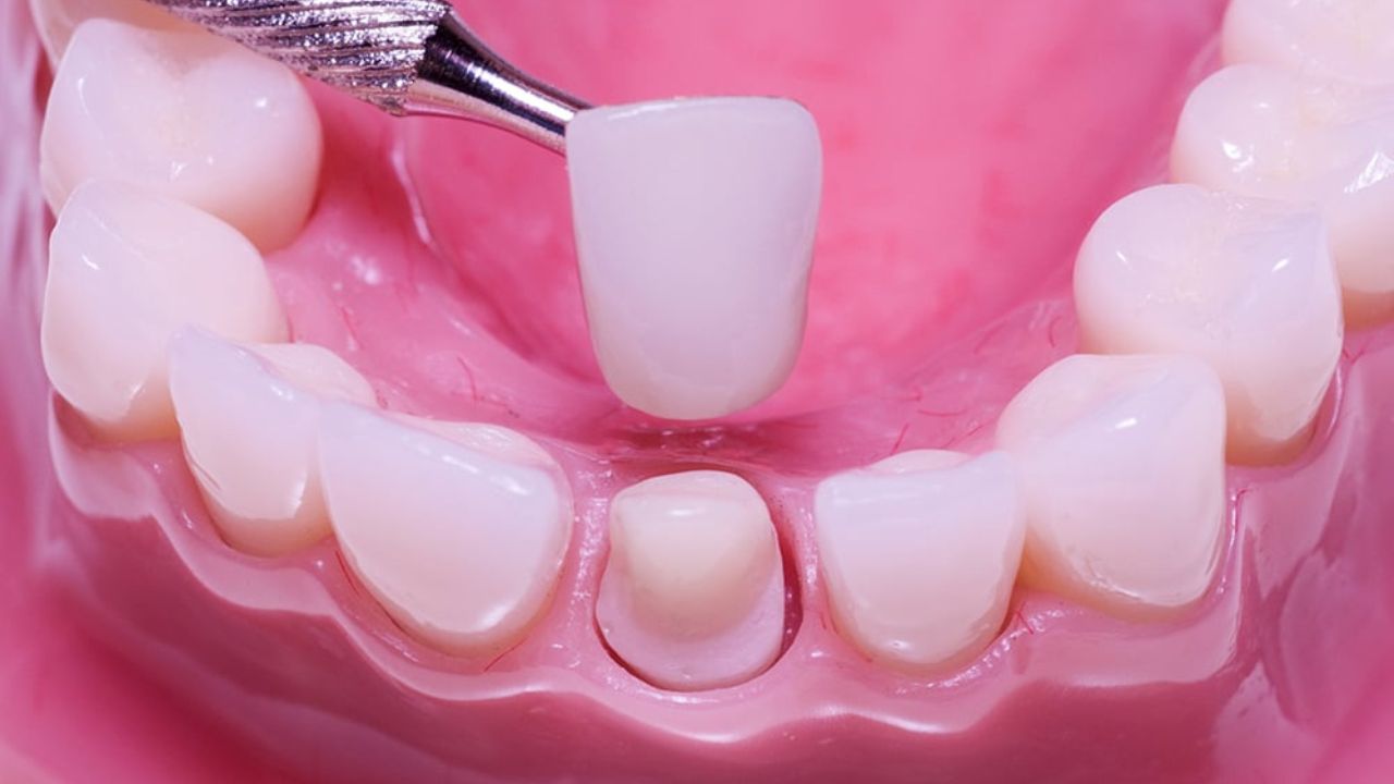Cách trồng răng sứ titan hiệu quả nhất