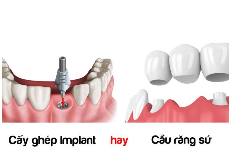 Bác sĩ tư vấn lựa chọn giữa cầu răng sứ và cấy Implant