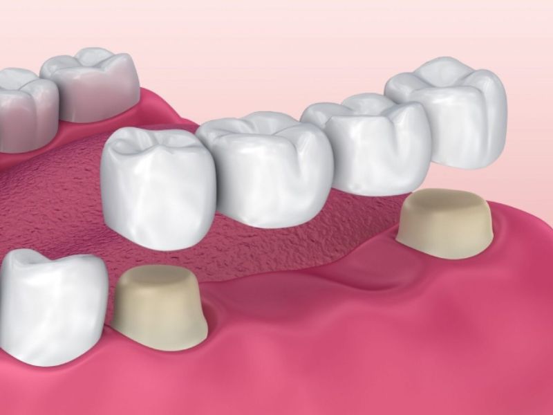 Hình ảnh cầu răng sứ phục hình răng mất