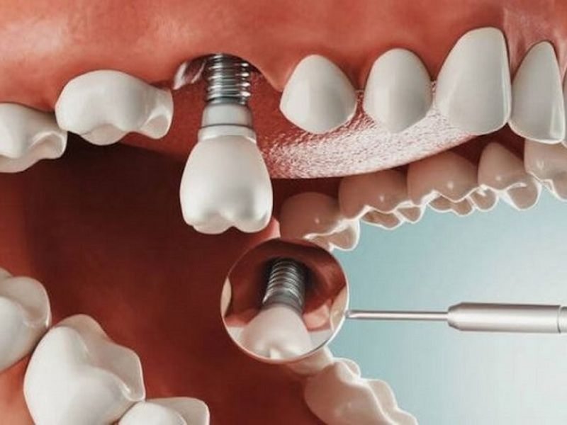 Răng Implant có thẩm mỹ và chức năng như răng thật