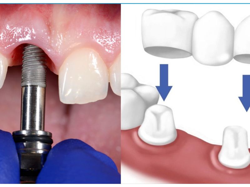 So sánh độ bền và tính thẩm mỹ giữa cầu răng sứ và Implant
