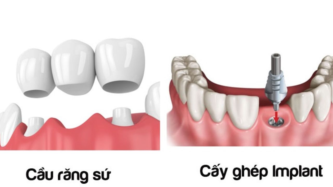 Cầu răng sứ và Implant loại nào tốt nhất