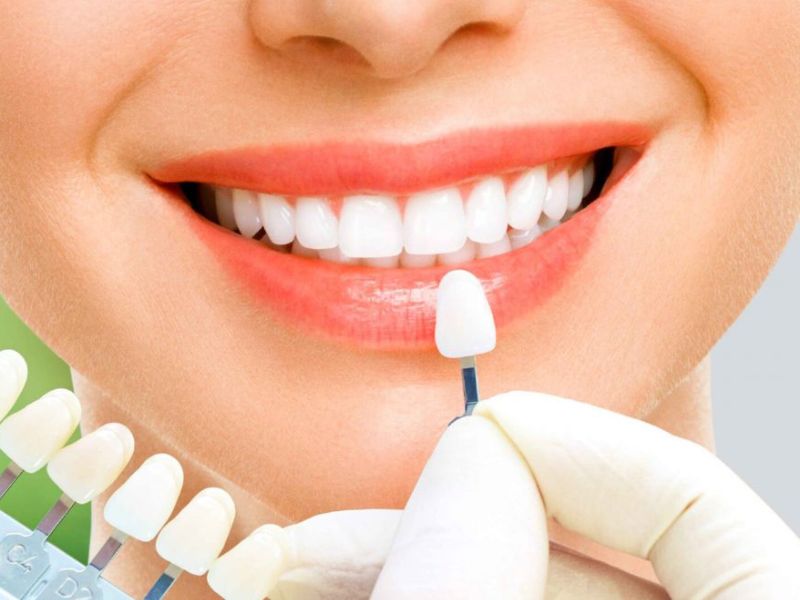 Dán sứ Vener giải pháp không xâm lấn, giúp chỉnh sửa những răng khấp khểnh, lệch nhẹ