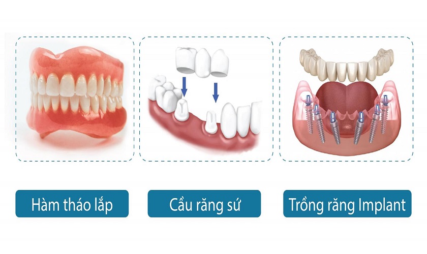 Các phương pháp trồng răng hiện nay