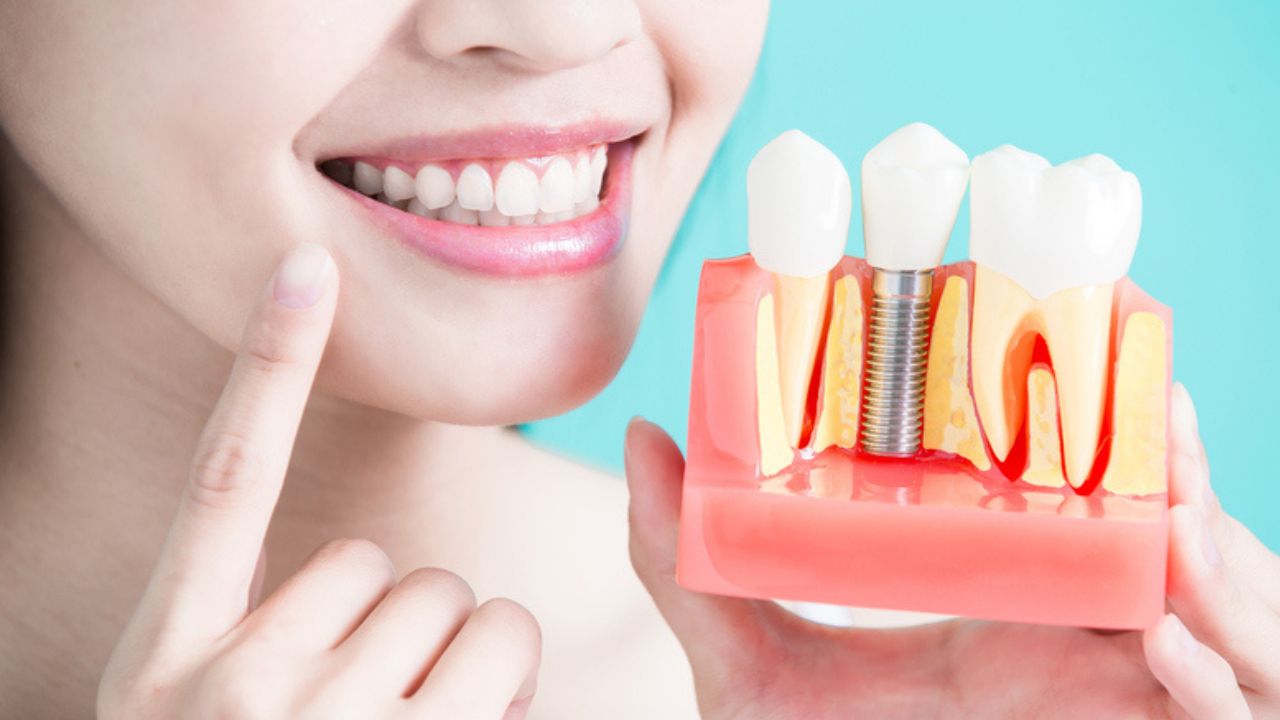 Có nên trồng răng không? Lợi ích và ảnh hưởng khi trồng răng