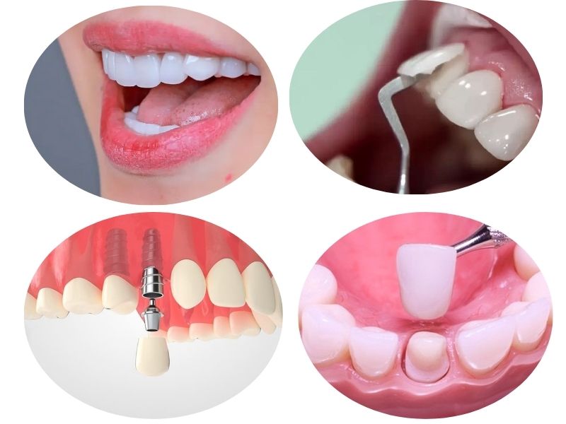 Nhiều phương pháp tạo răng khểnh hiện nay được áp dụng