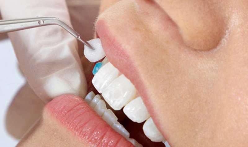 Trồng răng khểnh giúp nụ cười duyên, hài hòa với khuôn mặt