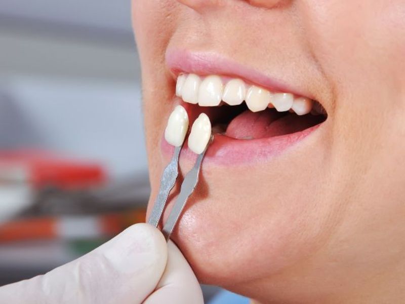 Ưu điểm nổi bật của dán Veneer không mài răng