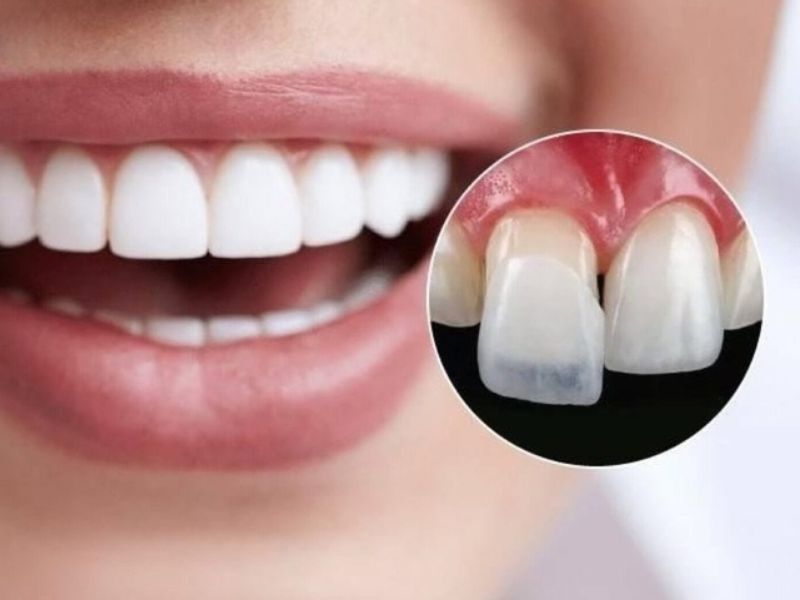 Các trường hợp nên dán sứ Veneer không mài răng