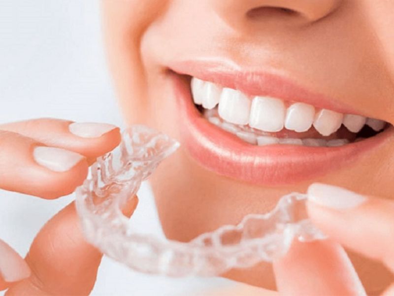 Hàm duy trì sau niềng răng có giá khoảng 700.000 – 4.000.000 đồng tùy vào loại hàm (hàm cố định, hàm trong suốt hay hàm nhựa tháo lắp)