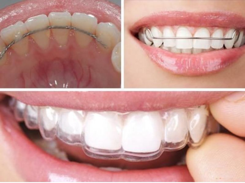 Đeo hàm duy trì sau niềng giúp cố định răng ở vị trí mới, ngăn răng chạy lại chỗ cũ, tránh răng xô lệch.
