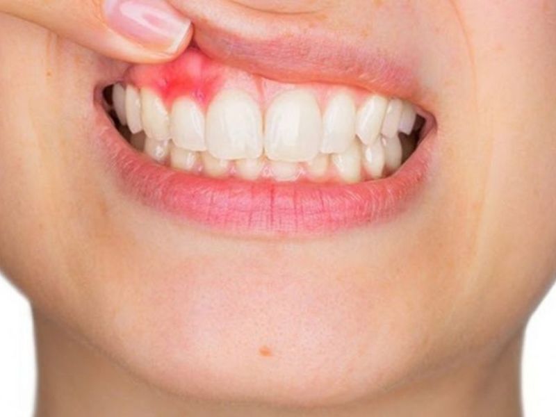 Viêm lợi, hôi miệng sau khi bọc răng sứ