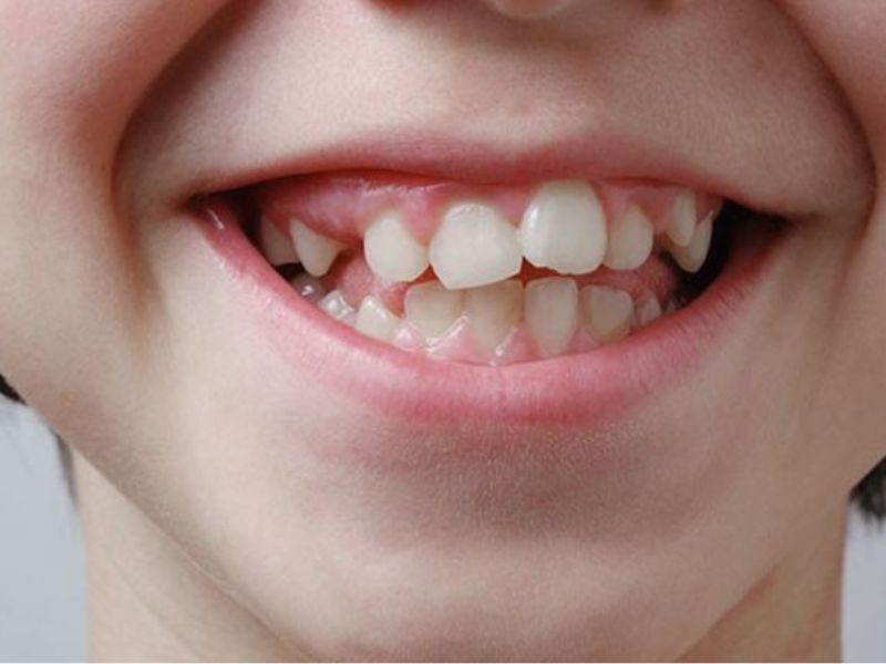 Lệch khớp cắn - hậu quả trồng răng sứ nguy hiểm