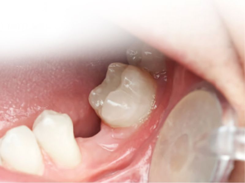 Nhổ răng hàm mà không trồng lại có thể gây nhiều hậu quả như tiêu xương hàm, lệch khớp cắn, khó khăn khi ăn nhai
