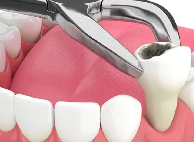Trường hợp chưa cần trồng lại răng hàm
