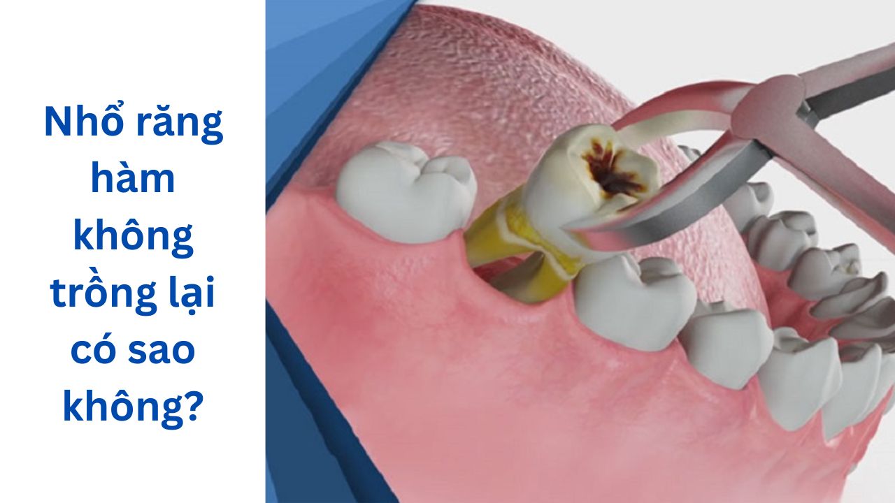 Nhổ răng hàm mà không trồng lại có sao không? có nguy hiểm không