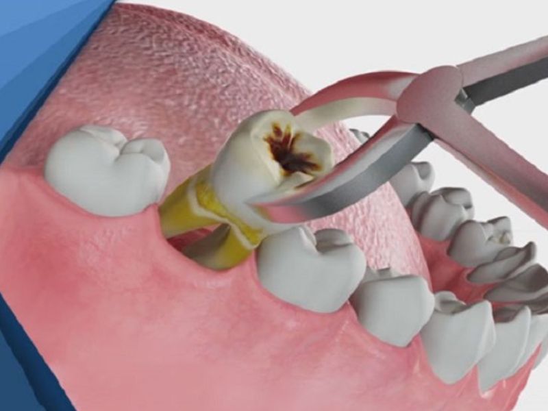 Nhổ răng không trồng lại có sao không 1