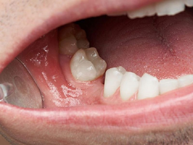 Các hậu quả khi nhổ răng không trồng lại