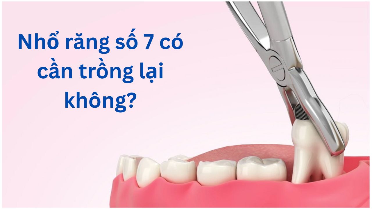 Nhổ răng số 7 có cần trồng lại không? bao lâu nên trồng lại