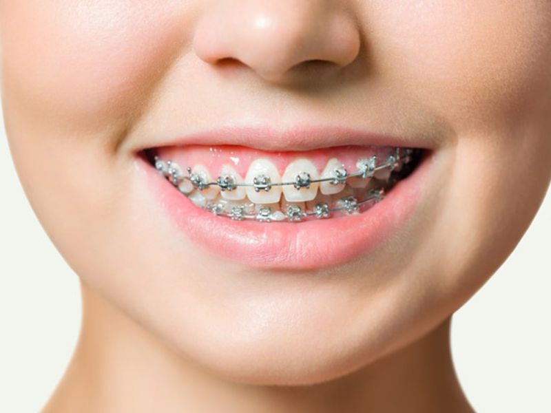 Niềng răng có thể vĩnh viễn nếu đeo hàm duy trì và chăm sóc răng miệng đúng cách