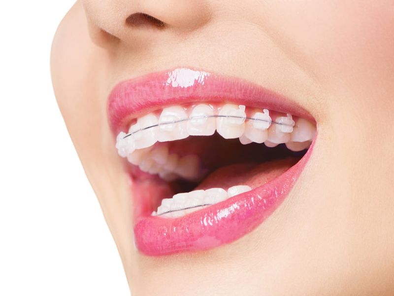 Răng có thể chạy lại sau niềng