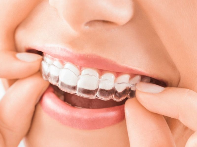 Cách duy trì kết quả niềng răng bền lâu