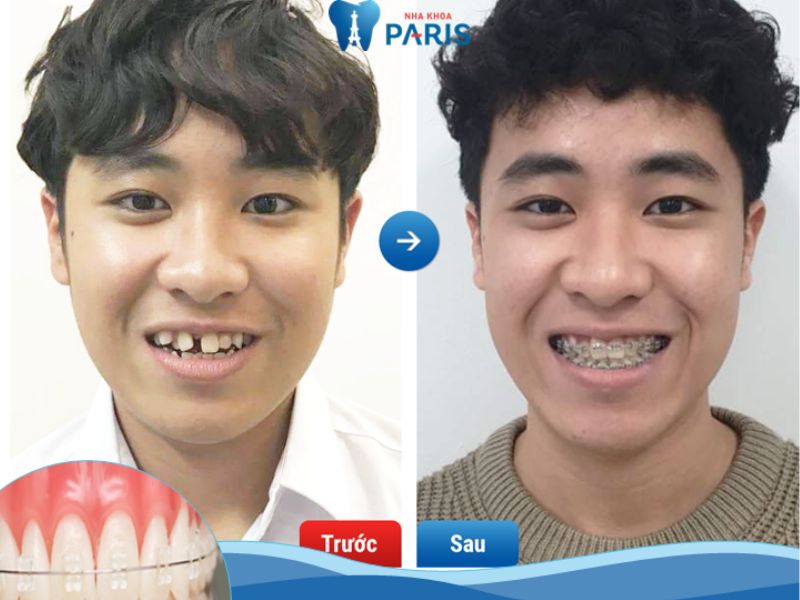 Niềng răng tại Nha khoa Paris – cam kết kết quả dài lâu