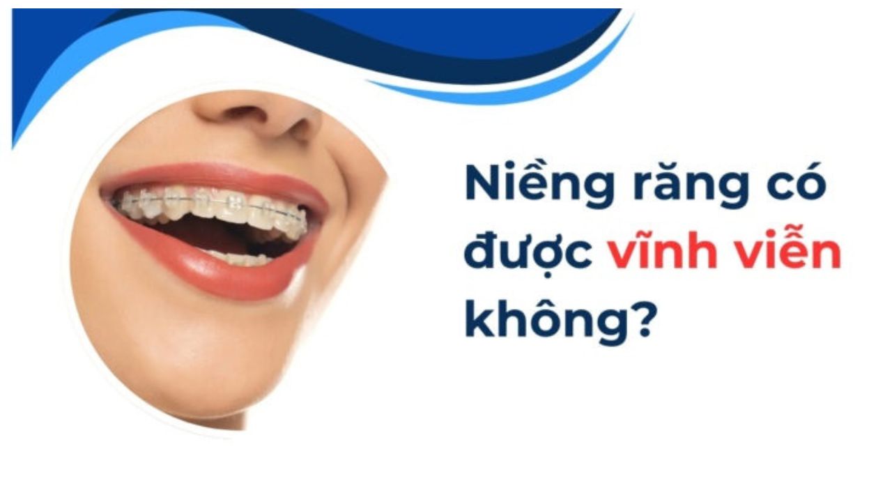 Niềng răng có được vĩnh viễn không? một số lưu ý cần biết