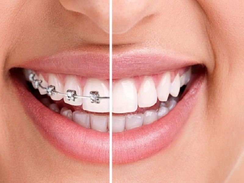 Cách rút ngắn thời gian niềng