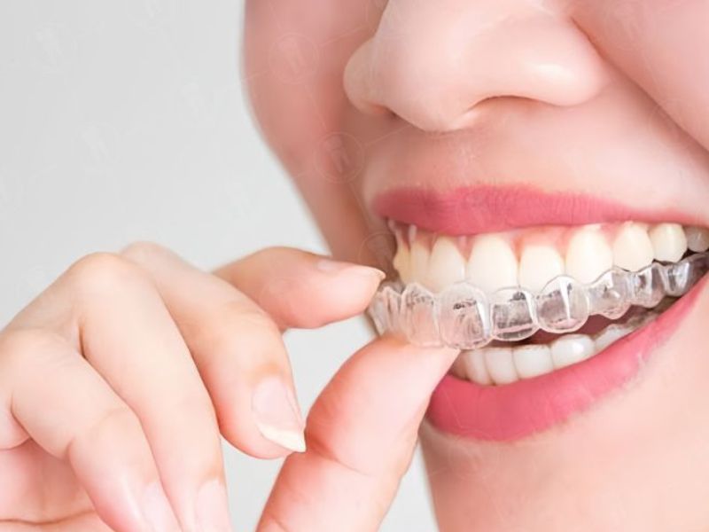 Các yếu tố ảnh hưởng tới thời gian niềng răng bao lâu