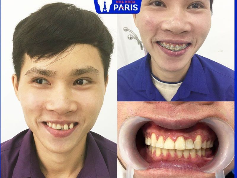Khách hàng niềng răng thành công, đúng tiến độ tại Nha khoa Paris