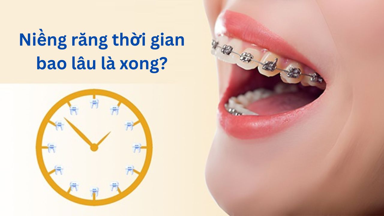 Niềng răng thời gian bao lâu là xong? Các yếu tố ảnh hưởng?