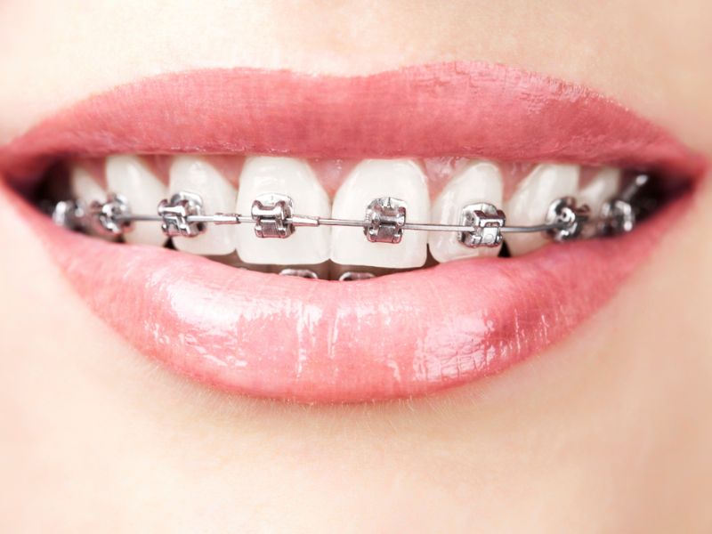 Niềng răng xong bị chạy răng lại vị trí cũ hoặc lệch hơn