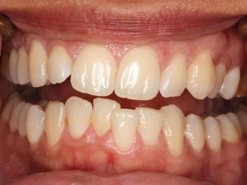 Dấu hiệu niềng răng xong bị chạy răng lại