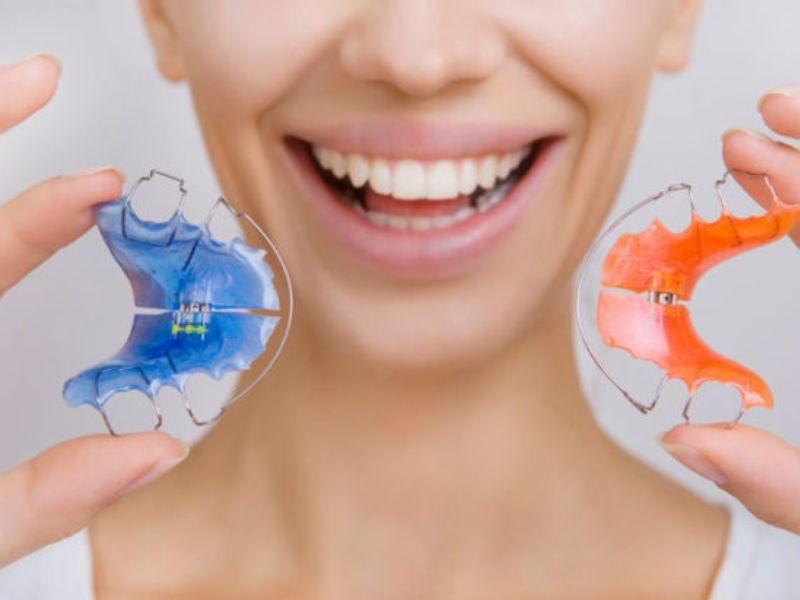 Nguyên nhân niềng răng xong bị chạy lại
