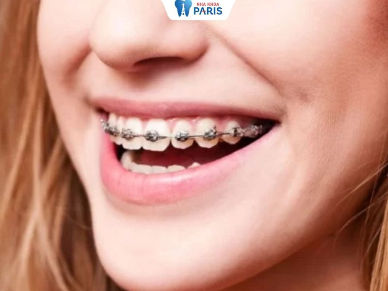 Niềng răng uy tín tại nha khoa Paris