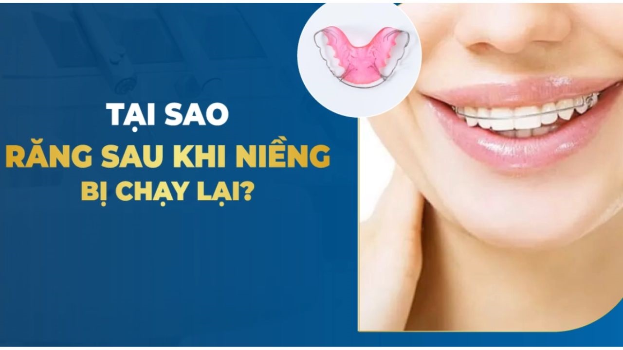 Niềng răng xong bị chạy răng: Nguyên nhân và cách khắc phục