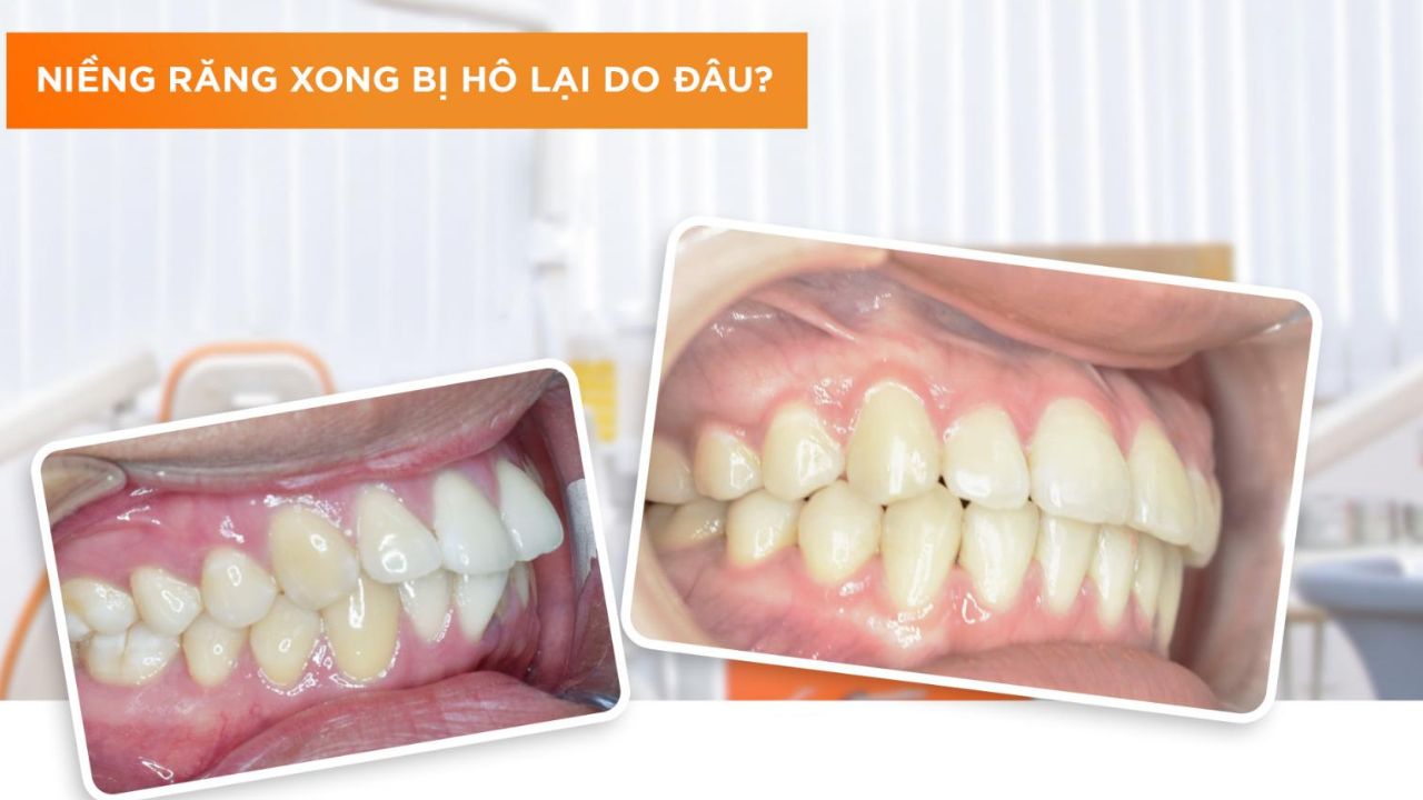 Niềng răng xong bị hô sao không? Nguyên nhân và cách khắc phục