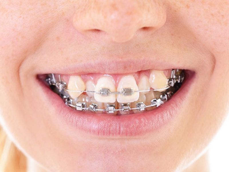 Răng khấp khểnh hoàn toàn có thể niềng để đưa răng về đúng vị trí