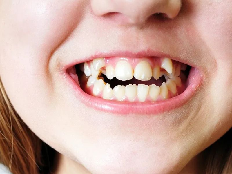 Cách nhận biết răng khấp khểnh bằng mắt thường