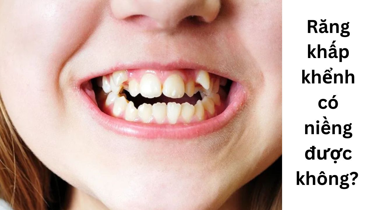 Răng khấp khểnh có niềng được không? [Giải đáp nhanh]