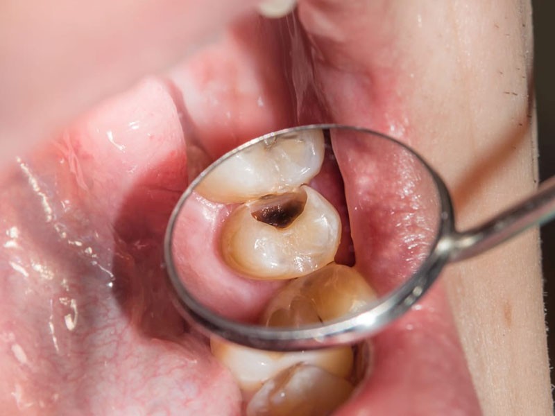 Chi phí trồng răng hàm bị sâu