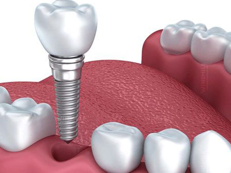 yếu tố ảnh hưởng tới giá trồng răng hàm bị sâu