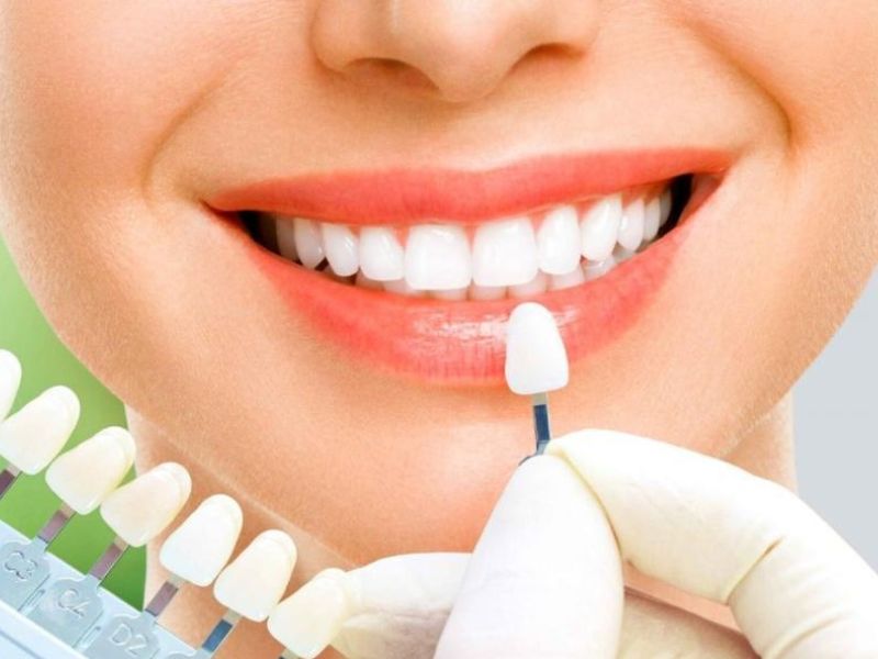 Răng còn nguyên vẹn, cần cải thiện thẩm mỹ nhẹ – Dán sứ Veneer siêu mỏng