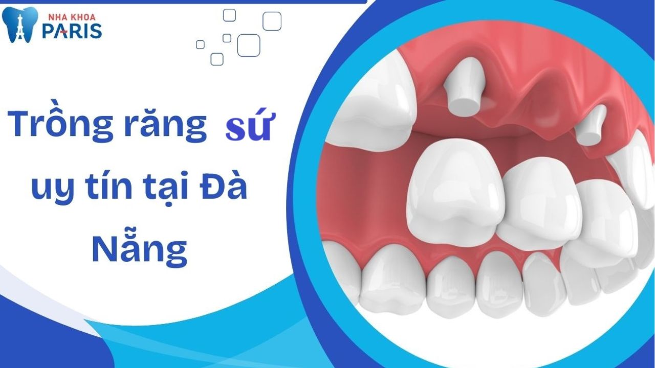 Trồng răng sứ tại Đà Nẵng – Gợi ý 7 địa chỉ uy tín
