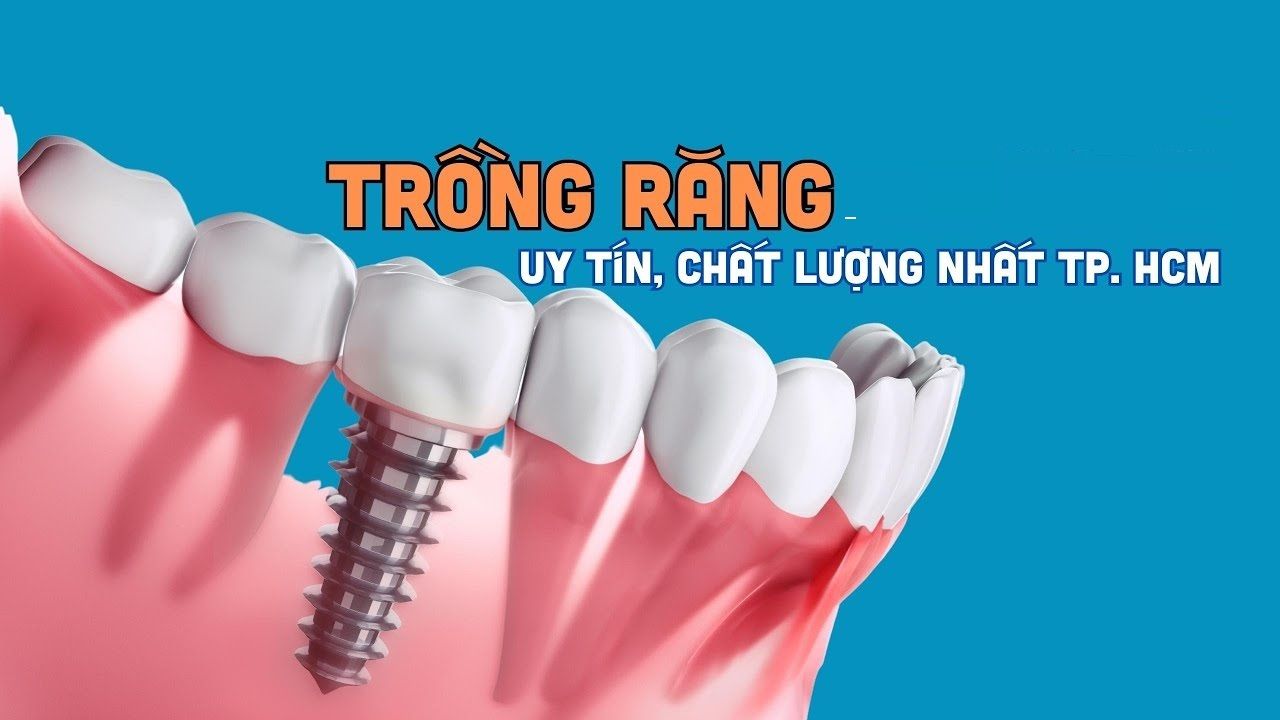 Trồng răng uy tín tphcm? Gợi ý 7 địa chỉ trồng răng uy tín