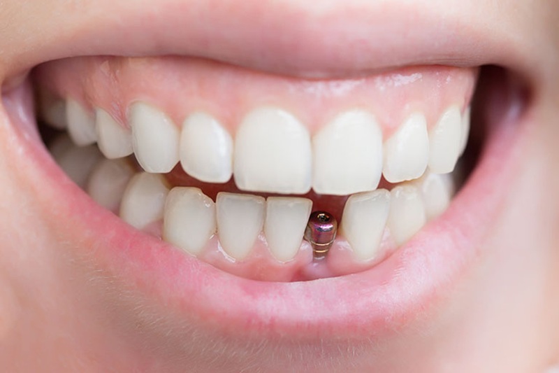 Dễ bị đào thải trụ Implant nếu thực hiện tại cơ sở kém chất lượng