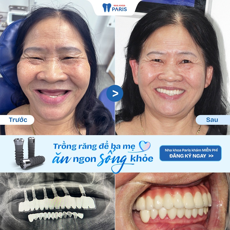 Hình ảnh trước và sau khi trồng răng Implant tại nha khoa Paris